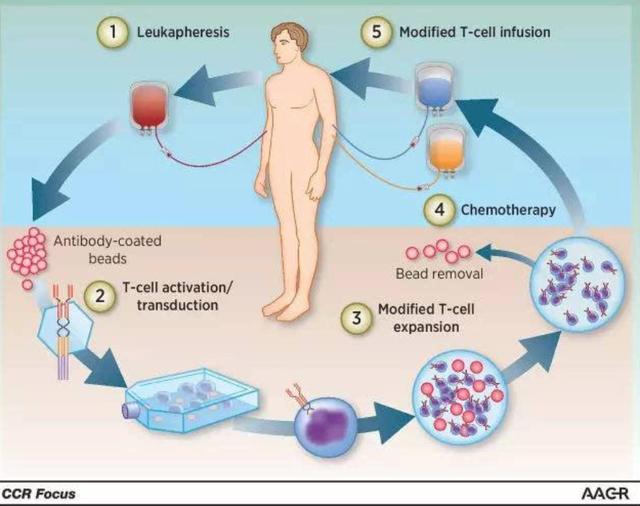 CAR-T 免疫细胞疗法:最有可能治愈癌症的方向
