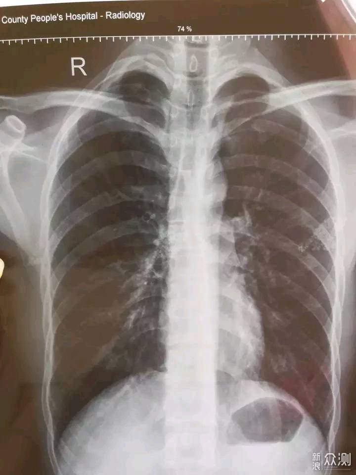 健康小知识:你对肺痨了解多少?